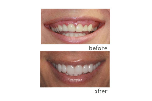 Before and After Teeth Image